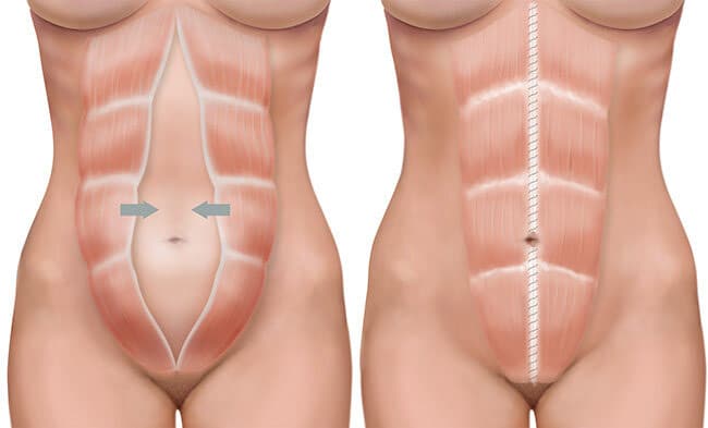 abdominal separation,stomach muscles separation,abdominal muscle separation,abdominal separation after birth,postpartum abdominal separation,abdominal separation symptoms,separation of abdominal muscles,what is abdominal separation,how do you know if you have abdominal separation,how do you know if you have diastasis recti